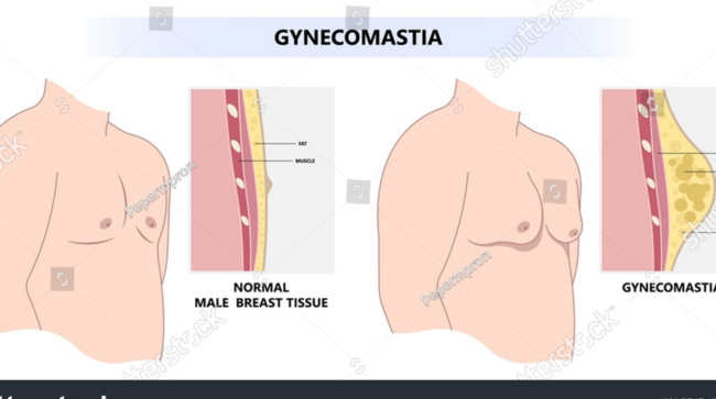 Gynecomastia