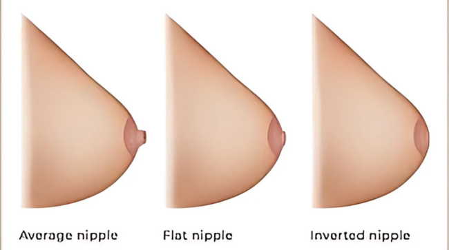 Inverted nipple